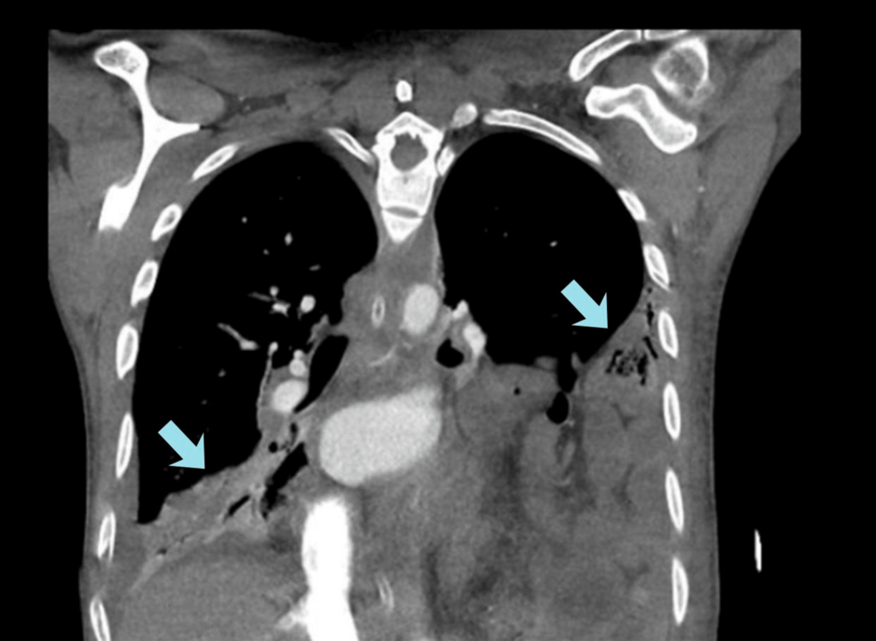 Medical Alert Rare, Fatal Cardiac Complication Unmasks Severity of Lemierre Syndrome