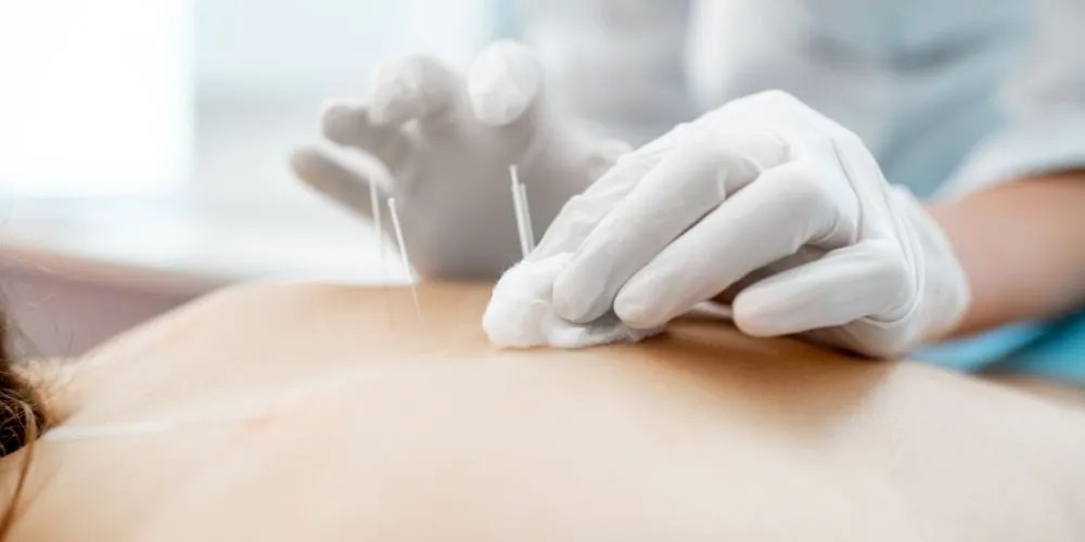Acupuncture Near Me: A Natural Path to Pain Relief and Wellness